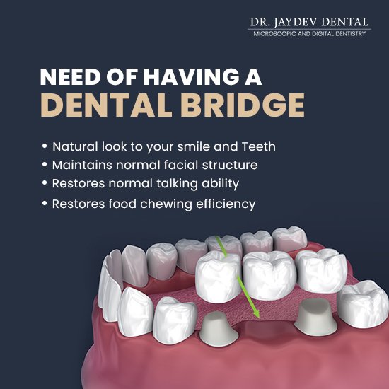 how-dental-bridge-is-placed-over-dental-implants